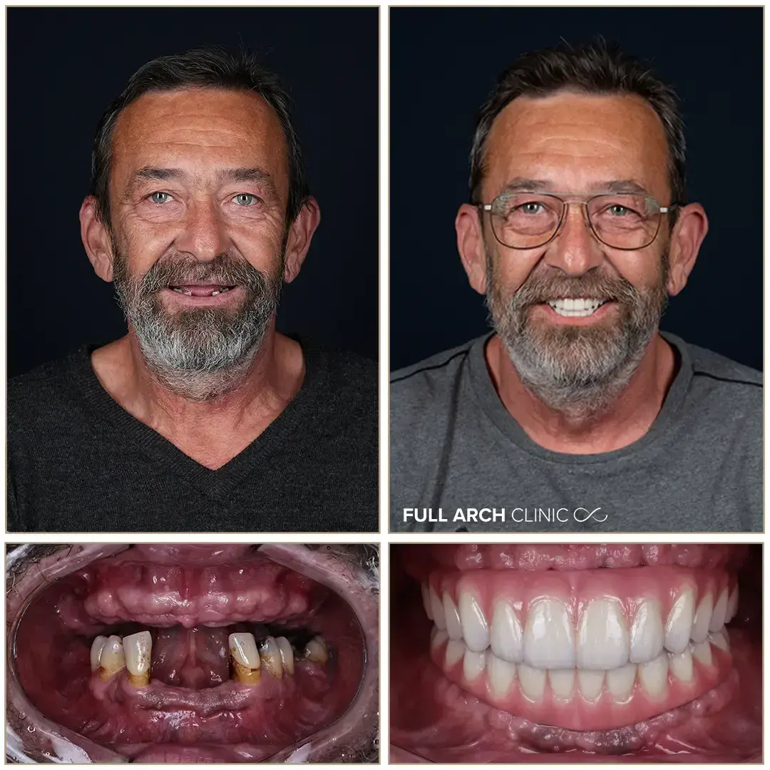 Înainte și după o reabilitare completă pe opt implanturi dentare, pacient tratat la Full Arch Clinic
