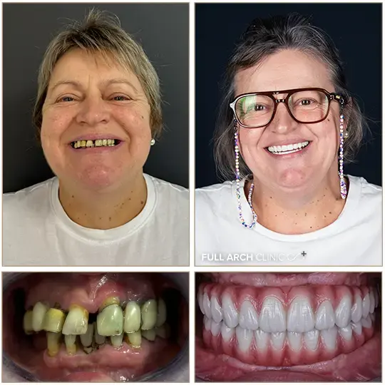 Înainte și după, dantură fixă pe implanturi dentare, pacient tratat la Full Arch Clinic