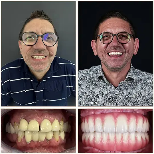 Înainte și după, dantură fixă pe nouă implanturi dentare, pacient tratat la Full Arch Clinic