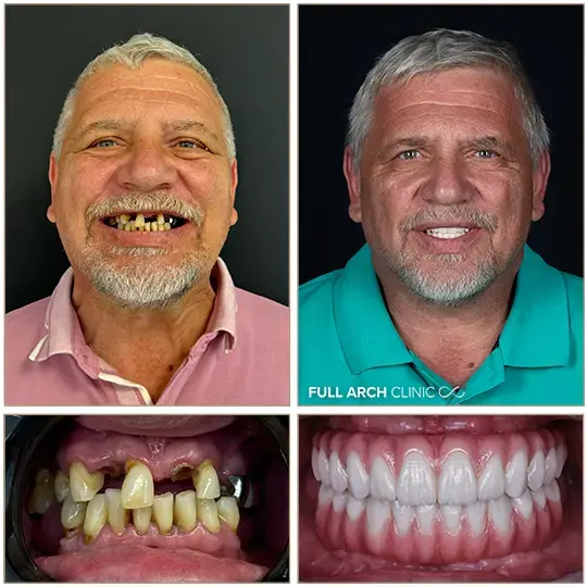 Înainte și după, reabilitare completă pe implanturi dentare, pacient tratat la Full Arch Clinic