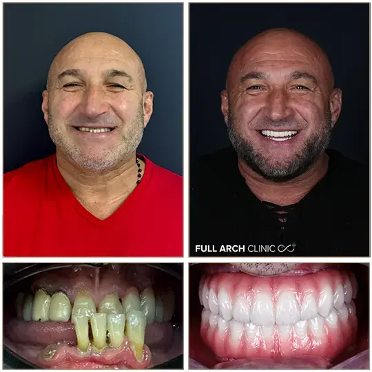 Înainte și după, dantură fixă pe implanturi dentare, pacient tratat la Full Arch Clinic