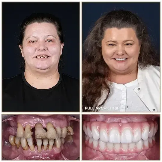 Înainte și după, dantură fixă pe implanturi dentare, după parodontopatie avansată