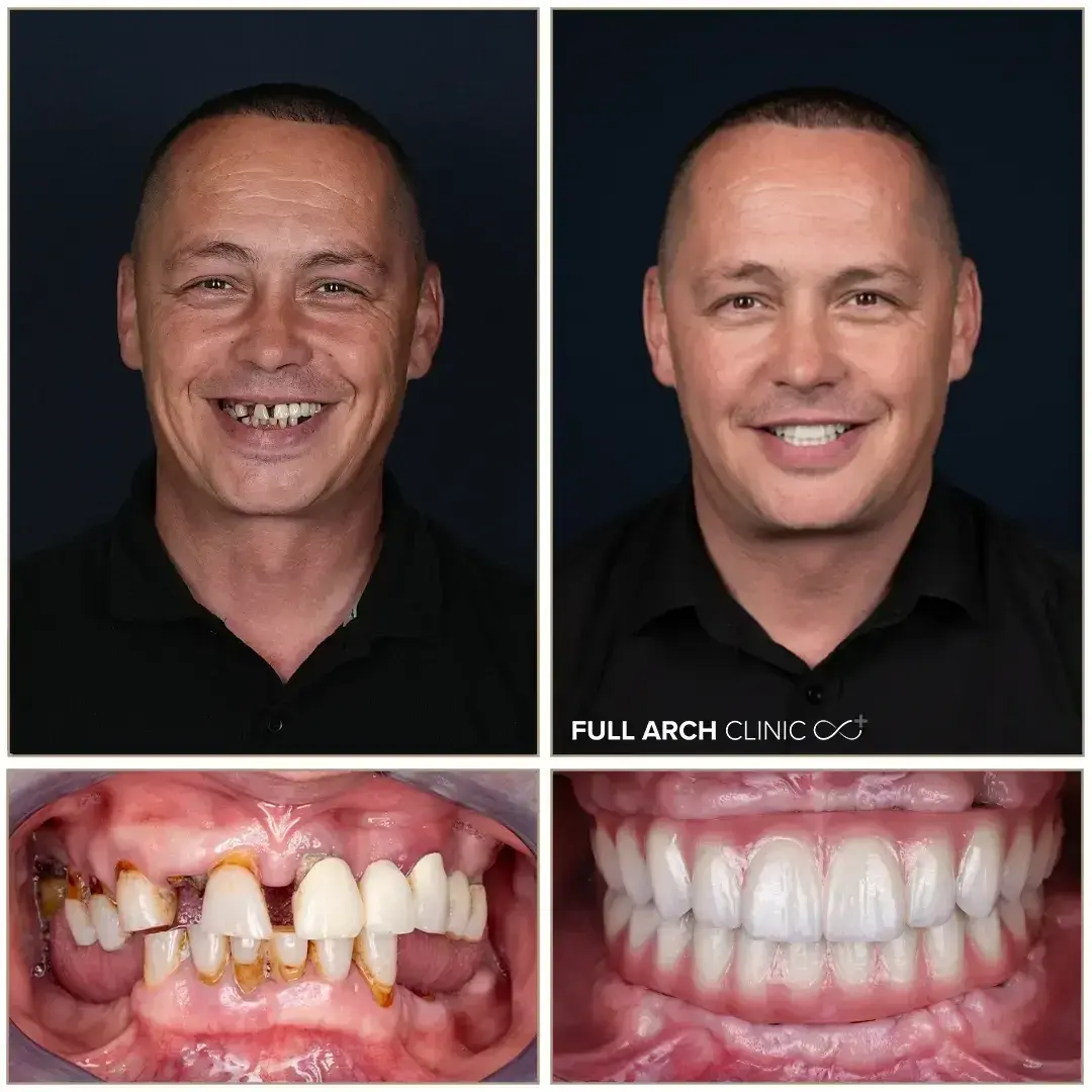 Înainte și după, reabilitare completă pe implanturi dentare, după parodontopatie avansată