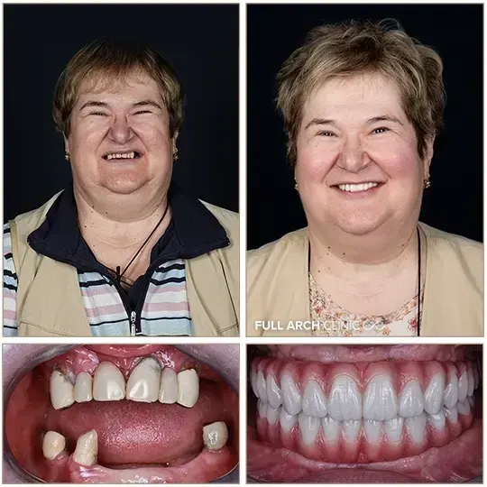 Înainte și după, dantură fixă pe implanturi dentare, după lucrări vechi care nu mai puteau fi reparate