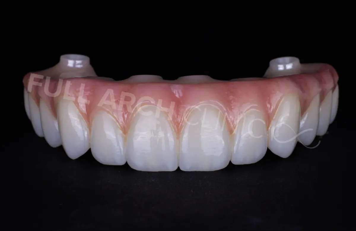Arcadă completă fixă pe implanturi, din ceramică stratificată pe structură de zirconiu, lucrare finită