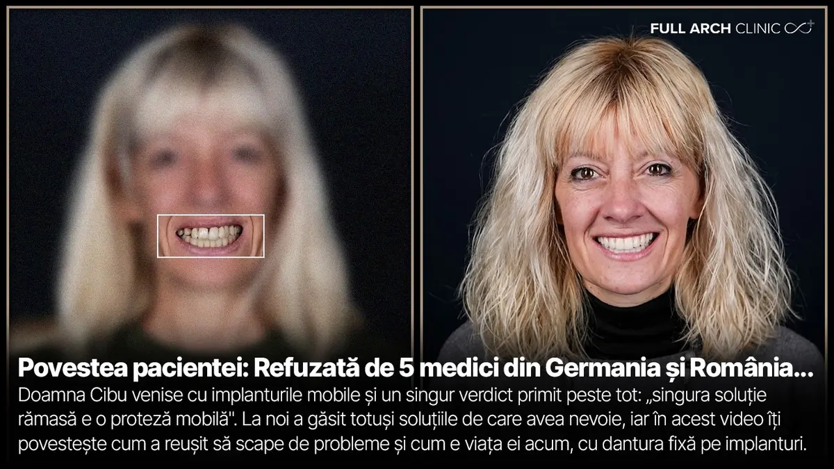 Parodontopatie avansată și os insuficient, rezolvate cu implanturi angulate