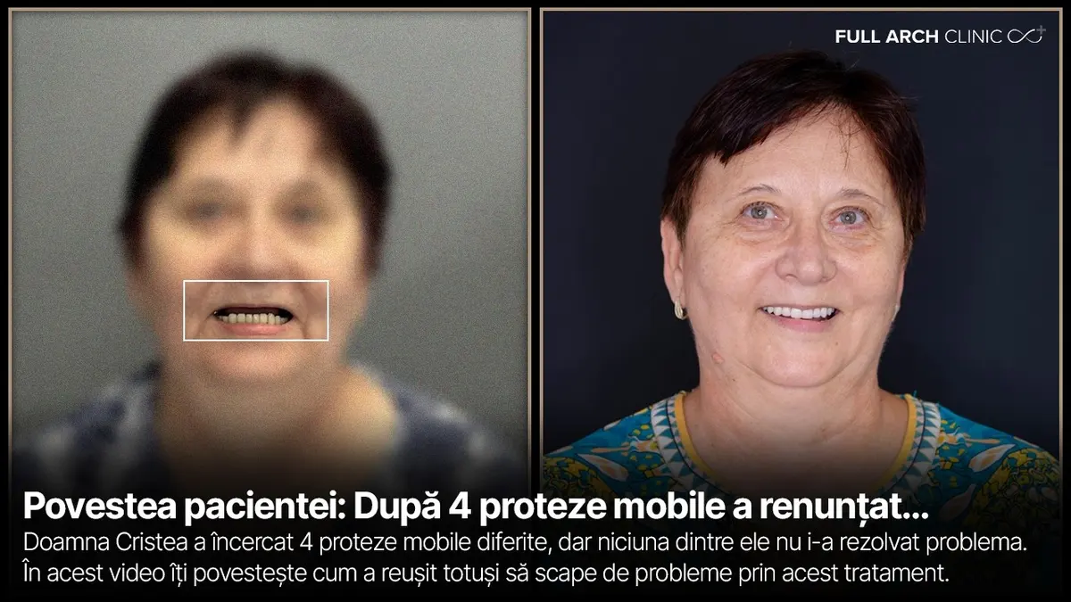De la proteză mobilă la lucrare fixă pe implanturi, ce s-a schimbat