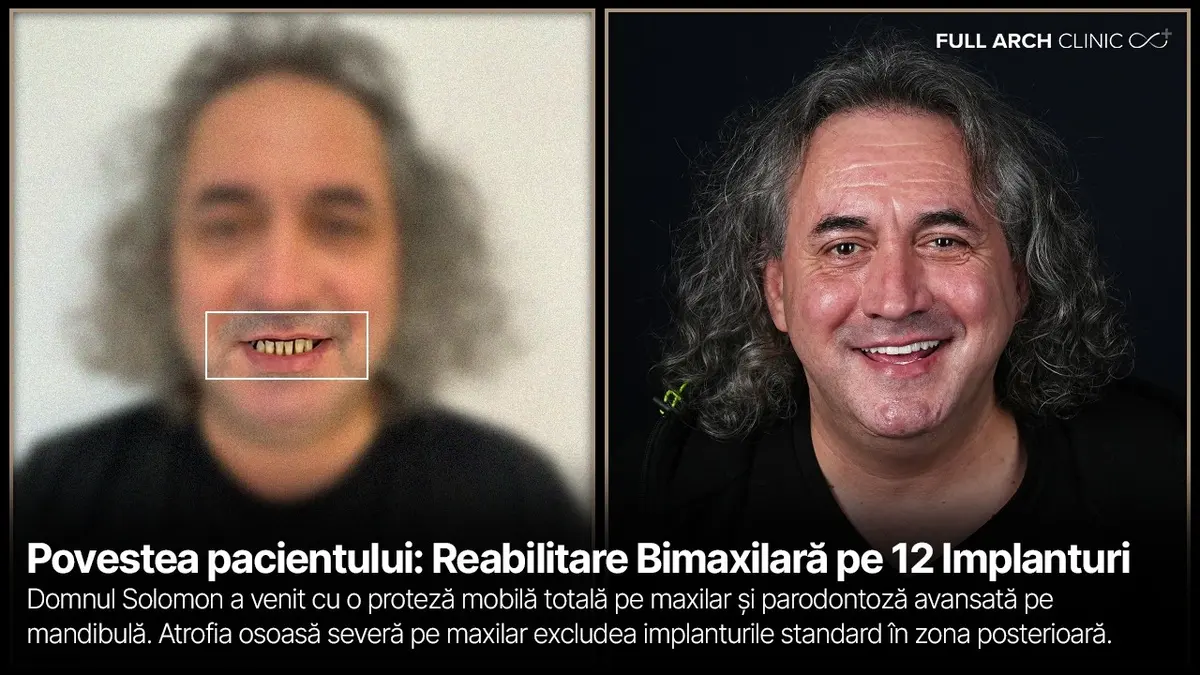 Dinți ficși pe douăsprezece implanturi, părerea pacientului